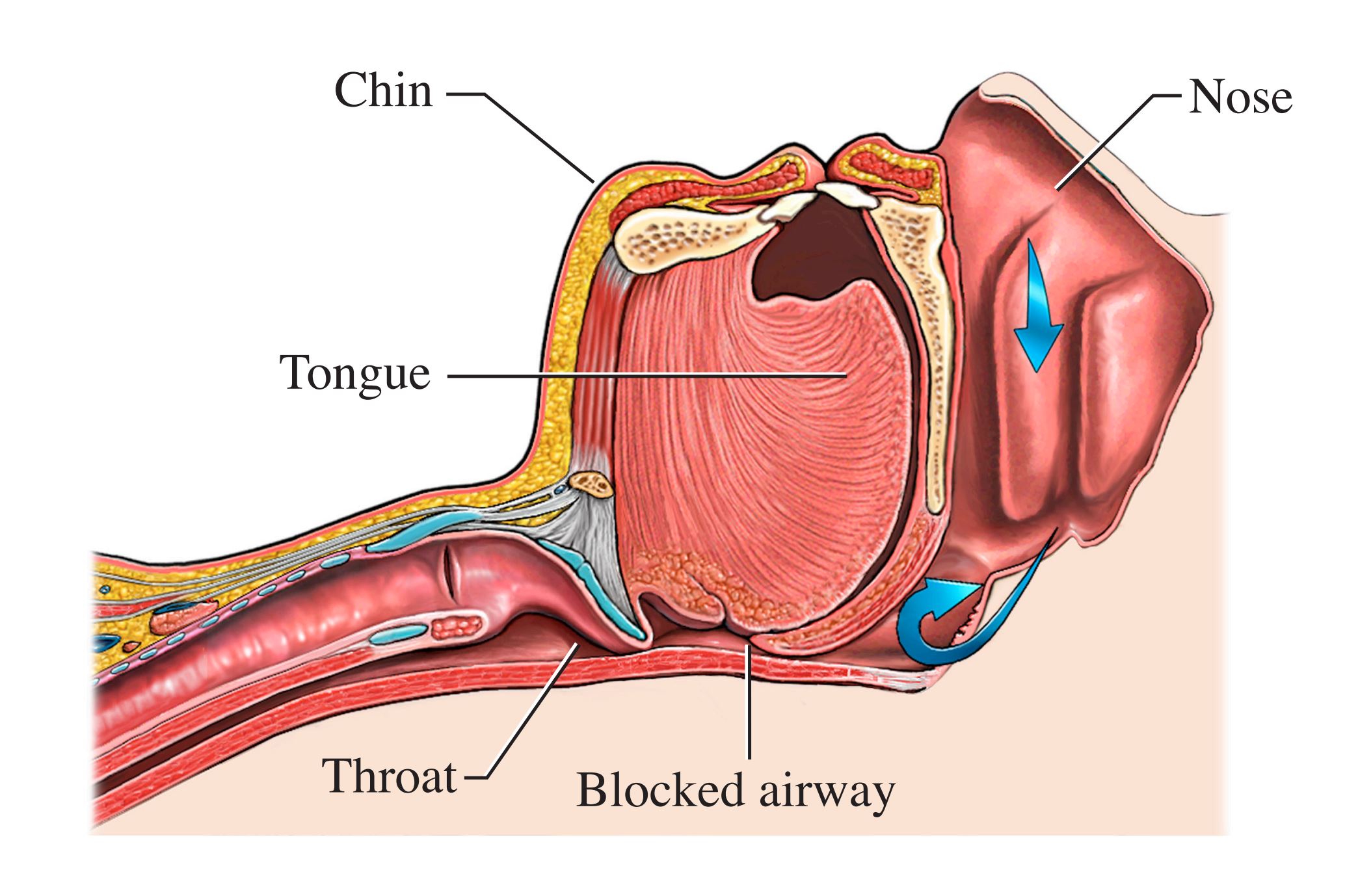 Sleep Apnea Causes And Risk Factors NHLBI NIH